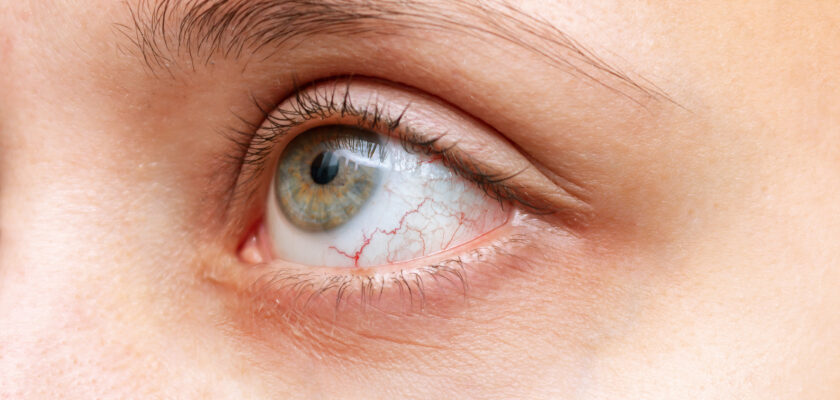 Dry Eyes – Symptoms and Home Remedies